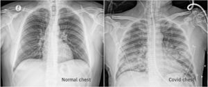 Normal or Covid chest