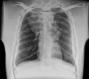 Agfa directadiography small chest